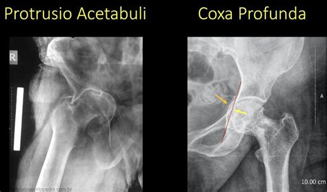 Coxa Profunda .